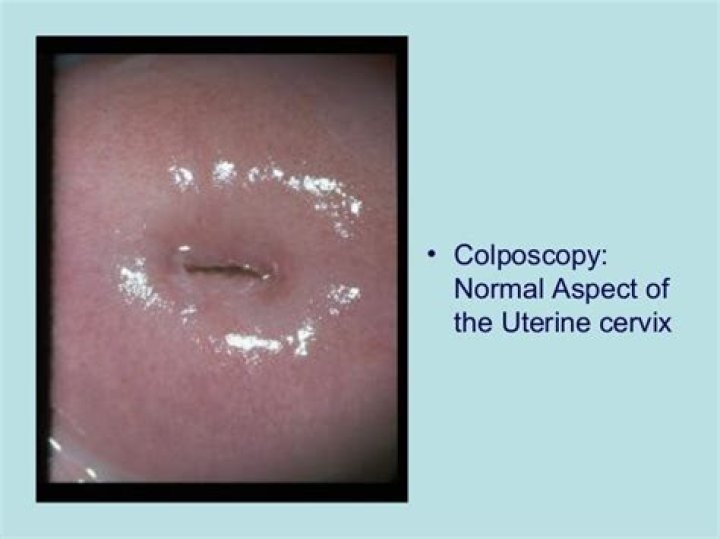 Are blood vessels on cervix normal