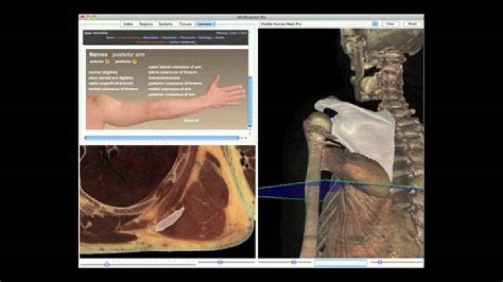 Can cadaver bone be rejected