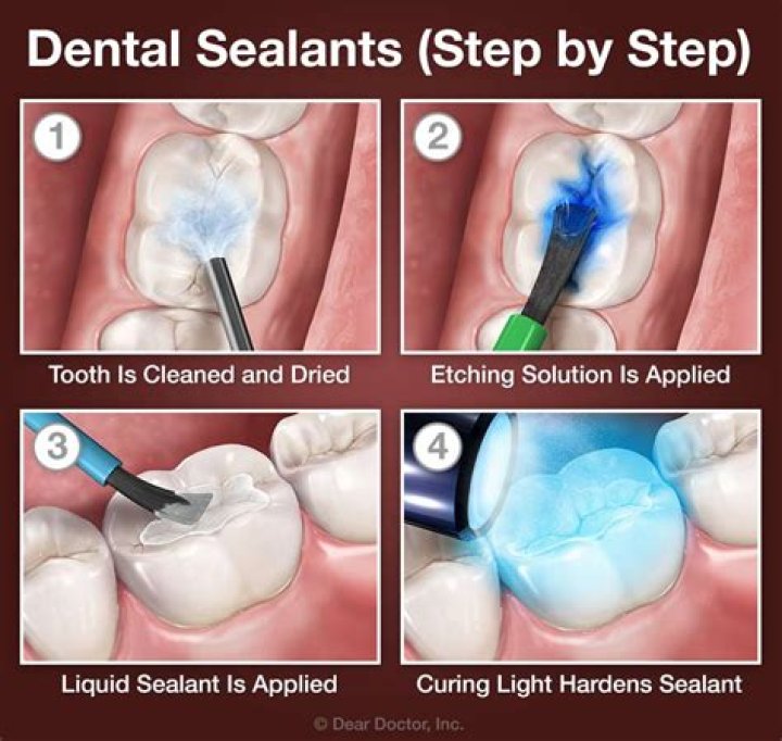 Can dental assistants do sealants