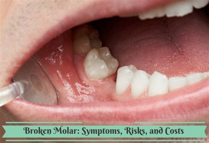 Can my broken molar be saved