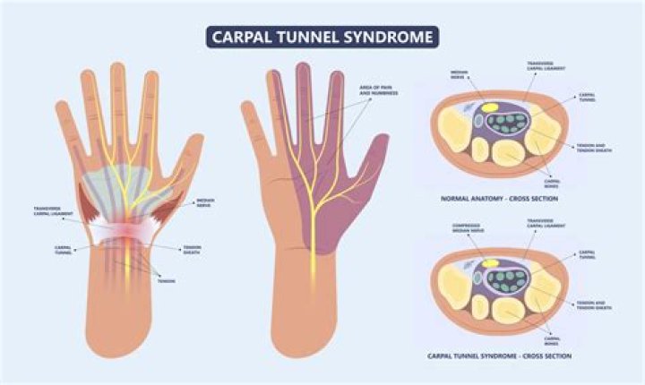 Can RSI cause carpal tunnel