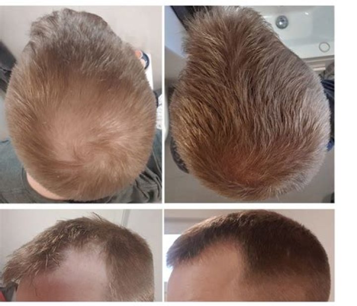 Can soft drinks cause hair loss