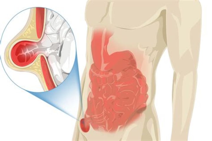 Can you get a hernia in your bladder