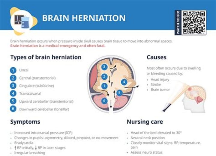 Can you survive a brain herniation