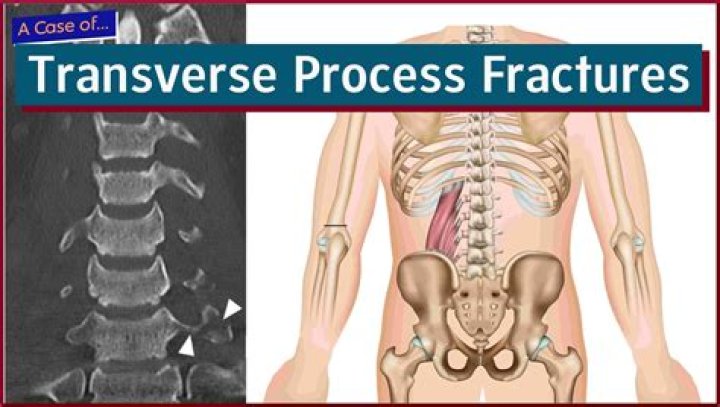 Do transverse process fractures heal