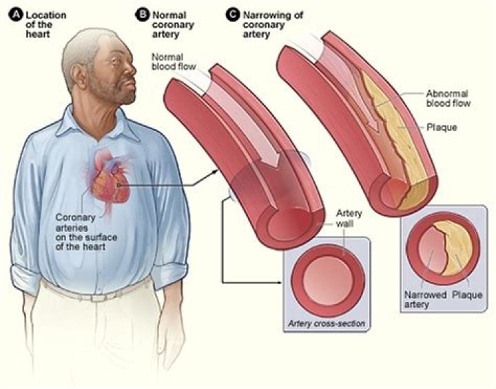 Does artery blockage cause high blood pressure