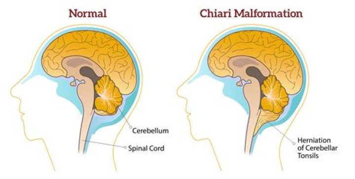 Does Chiari malformation cause hydrocephalus