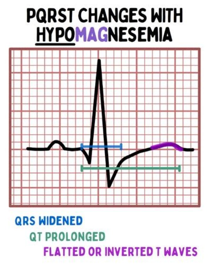 Does low magnesium cause arrhythmia