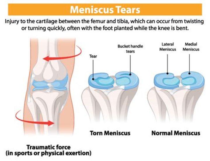 How do you check for ACL