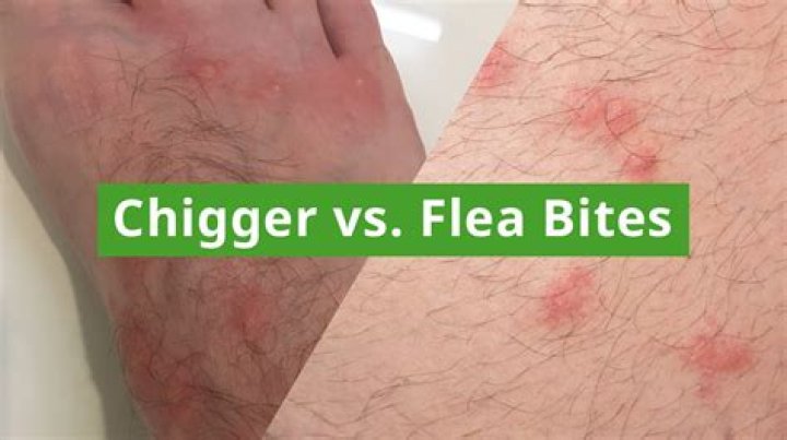How do you know if you have chigger bites