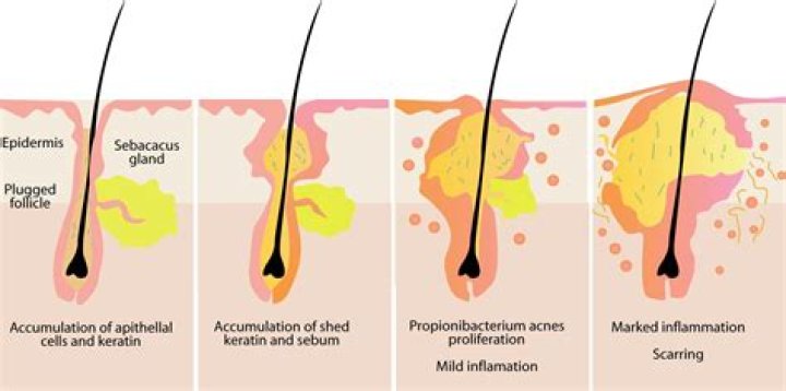 How do you prevent overactive sebaceous glands