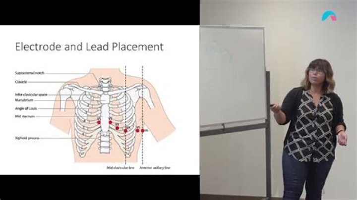 How do you remember ECG lead placement