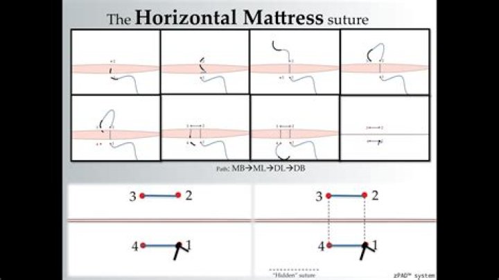 How do you suture a horizontal mattress