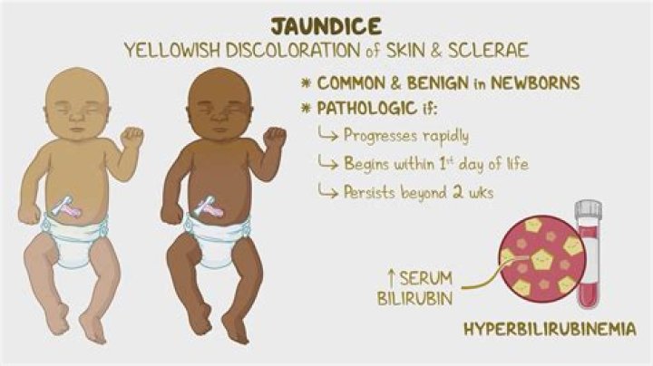 How do you test for neonatal jaundice