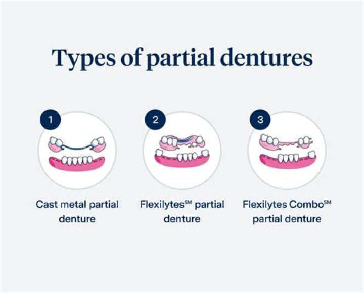 How does a partial stay in your mouth
