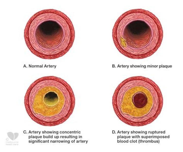 How does plaque build up in the coronary arteries