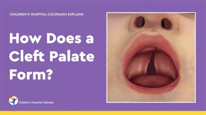 How is cleft palate corrected