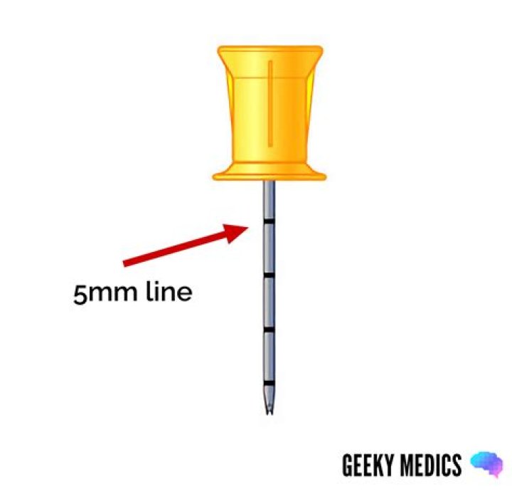 How long can an IO needle stay in