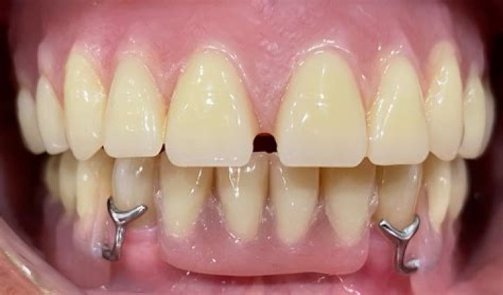 How long can you leave dentures in Polident