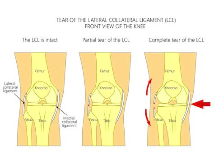 How long does a Grade 2 LCL sprain take to heal