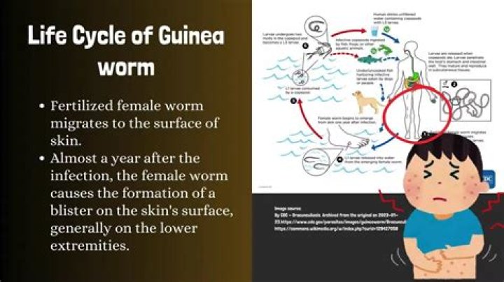 How long does it take to remove a guinea worm