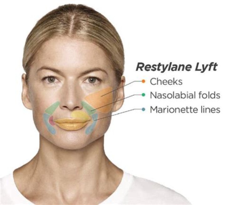 How long does Restylane LYFT last