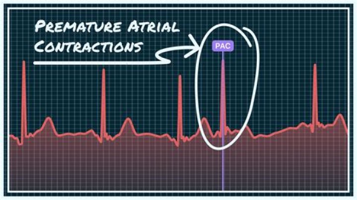 How many premature atrial contractions are normal