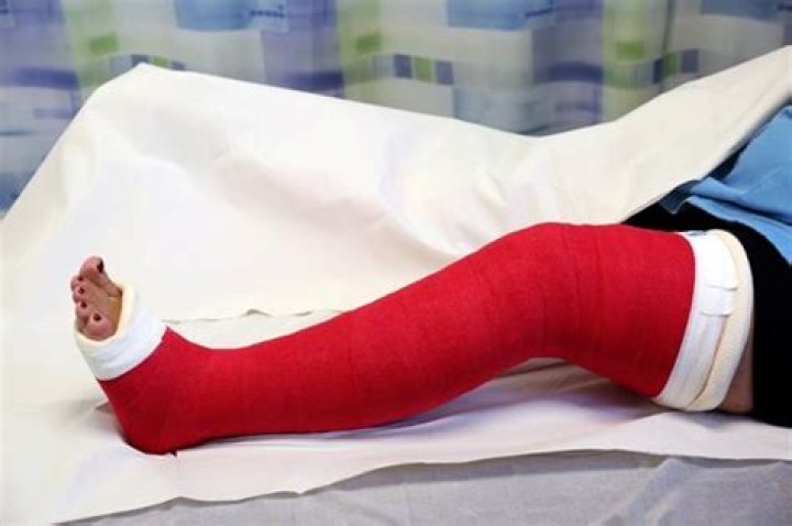 How tight is a cast supposed to be