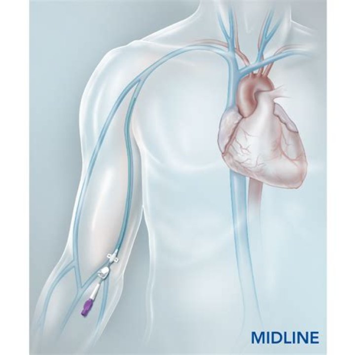 Is a midline catheter A central line