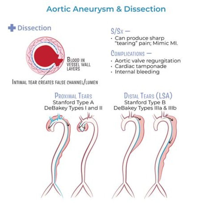 Is aortic dissection a false aneurysm