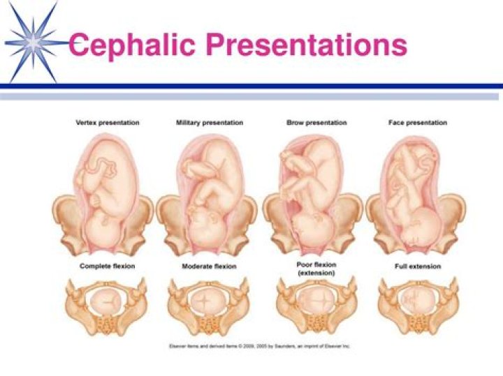 Is cephalic presentation is good for normal delivery