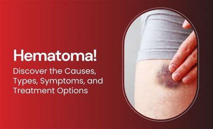 Is hematoma serious