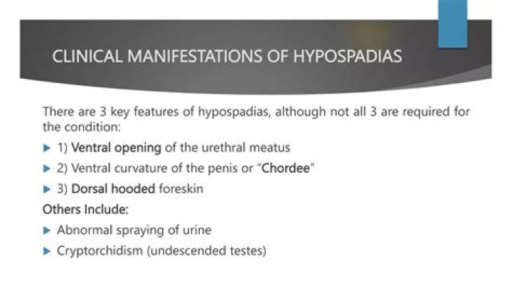 Is hypospadias dorsal or ventral
