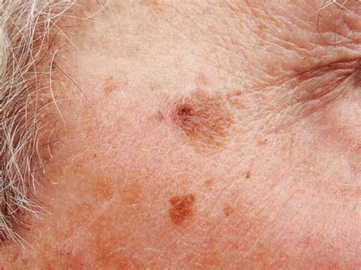Is lentigo maligna cancerous