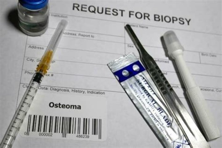 Is osteoma removal covered by insurance