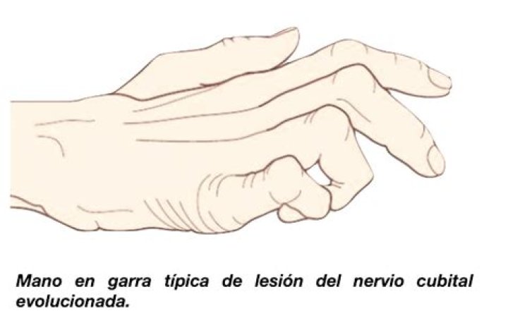 ¿Qué pasa si se daña el nervio cubital