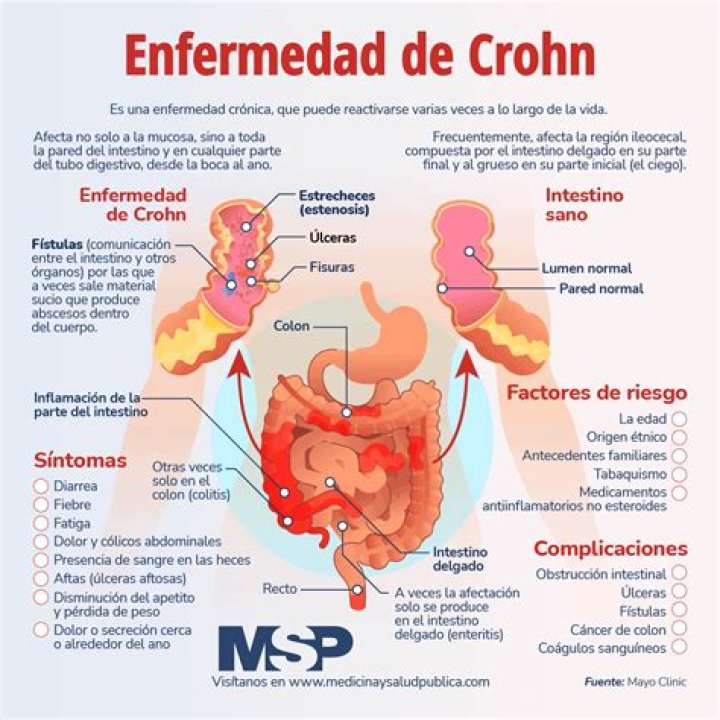 ¿Qué síntomas da la enfermedad de Crohn