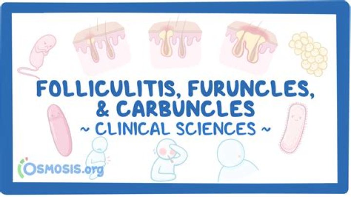 What are Furuncles carbuncles