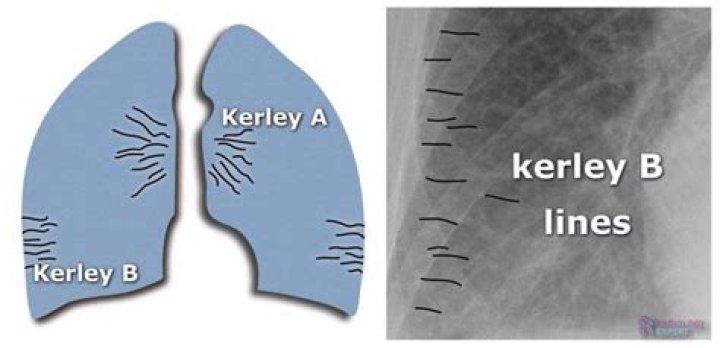 What are Kerley A lines