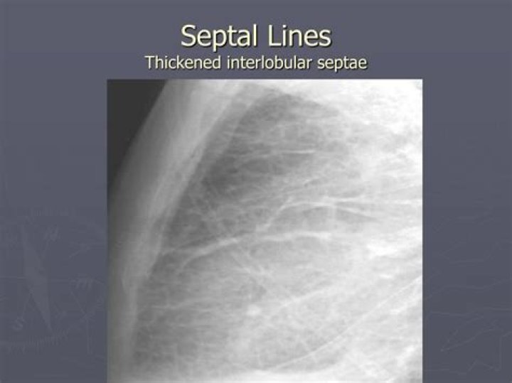 What are septal lines
