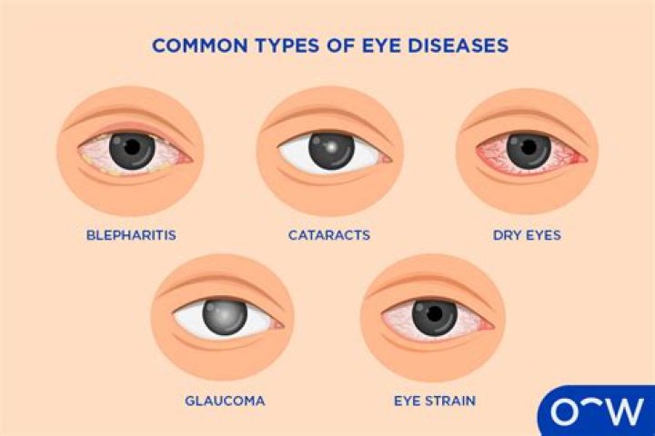 What are the different eye diseases