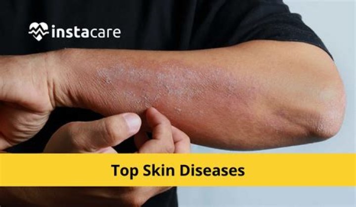 What are the diseases of skin