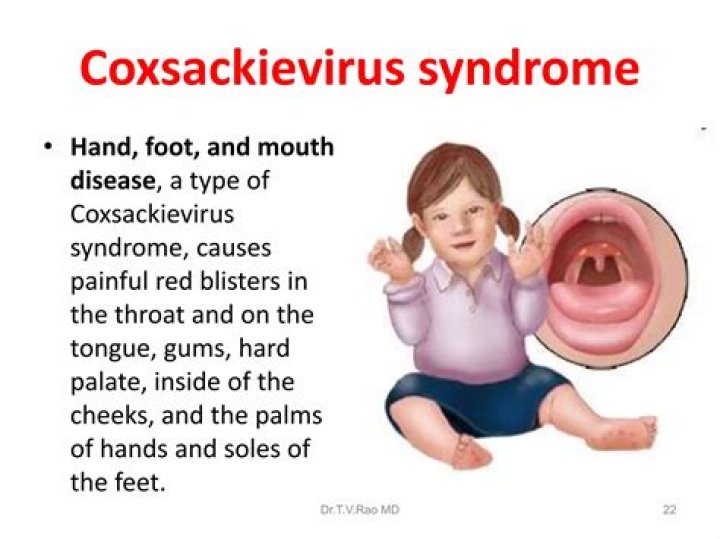 What are the symptoms of coxsackievirus in adults