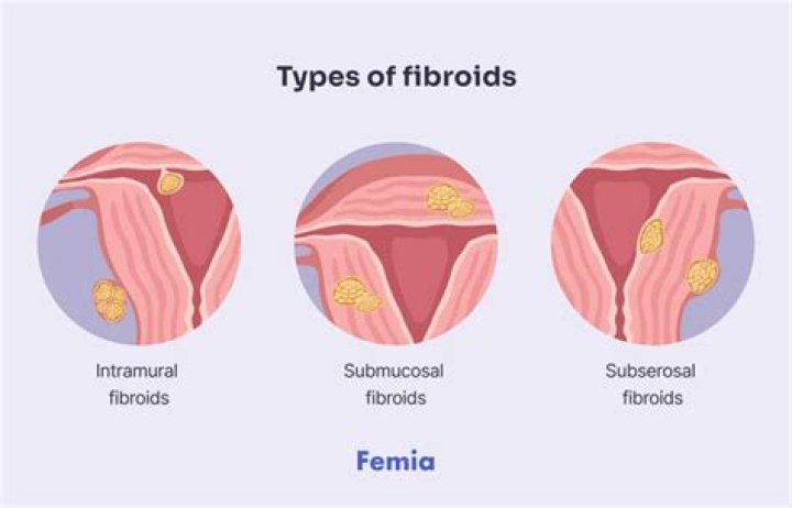 What are the types of fibroid