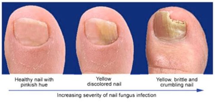 What bacteria causes nail fungus
