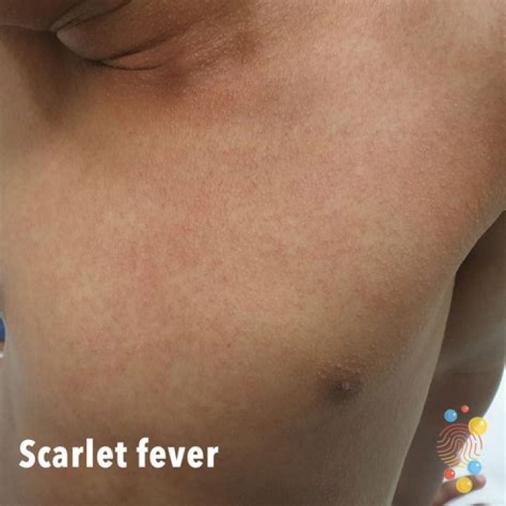 What can cause a sandpaper rash