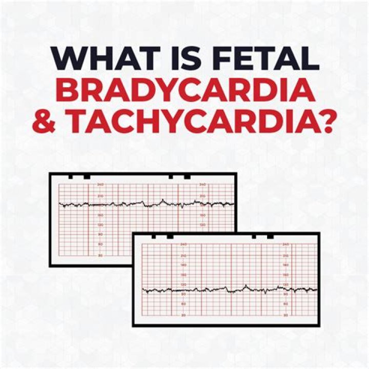 What can you do for fetal tachycardia