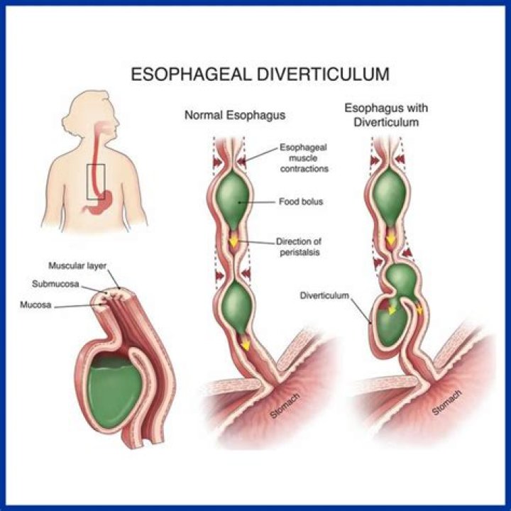 What causes a diverticulum in the esophagus