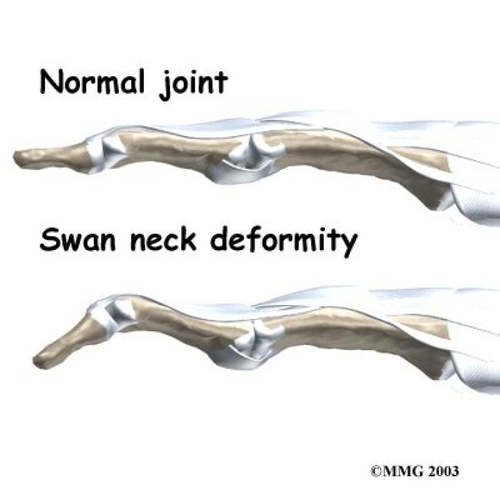 What causes a swan neck deformity