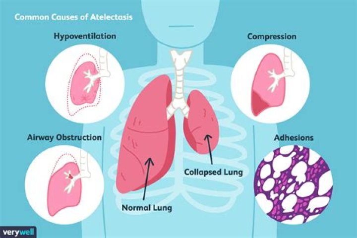 What causes absorption atelectasis